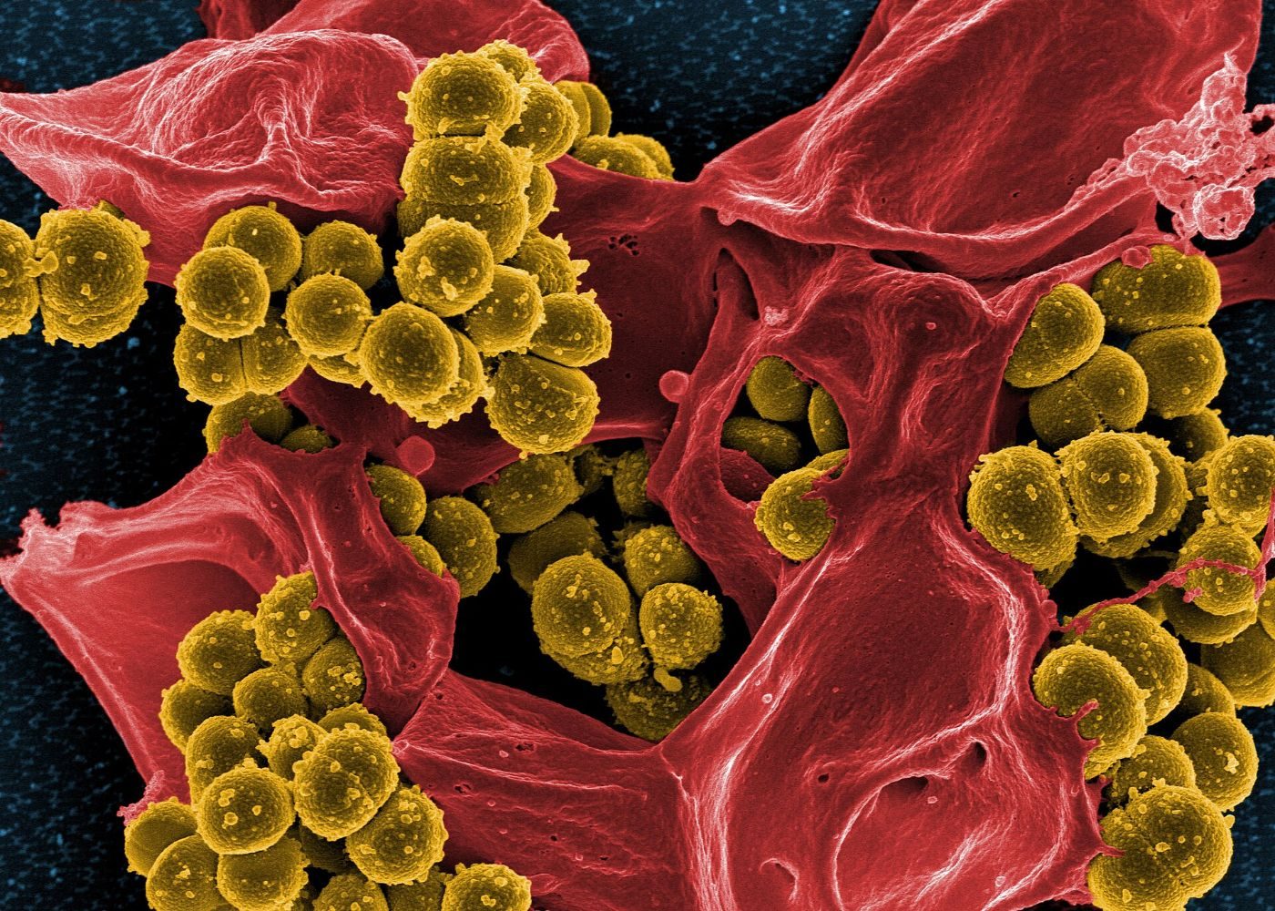 Colorized electron micrograph of clusters of round yellow bacteria on a red human immune cell